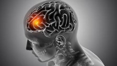 Ministério da Saúde inclui no SUS tratamento para AVC isquêmico