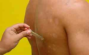 Brasil ocupa segundo lugar no ranking mundial em número de casos de Hanseníase