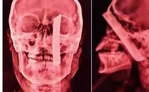 Mulher sobrevive após cirurgia para retirar de lâmina de faca presa no crânio 