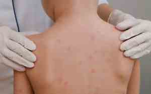 Bahia registra mais de 250 casos de meningite nos oito meses de 2023