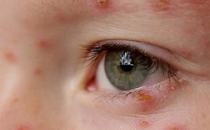 Em falta no país, Ministério da Saúde faz compra internacional de vacina contra catapora