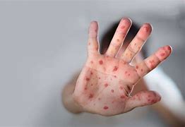 Núcleo Regional intensifica ações e campanhas de prevenção ao sarampo no Sudoeste da Bahia 