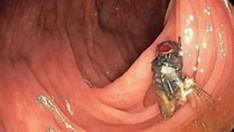 Médicos encontram mosca viva dentro de intestino de paciente durante exame