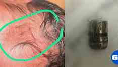 Bebê é atingida por bala perdida em hospital quatro horas após nascer em Recife