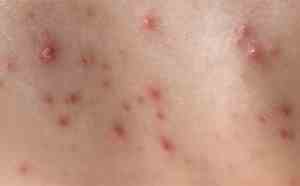 Sesab emite alerta após aumento de casos de catapora na Bahia